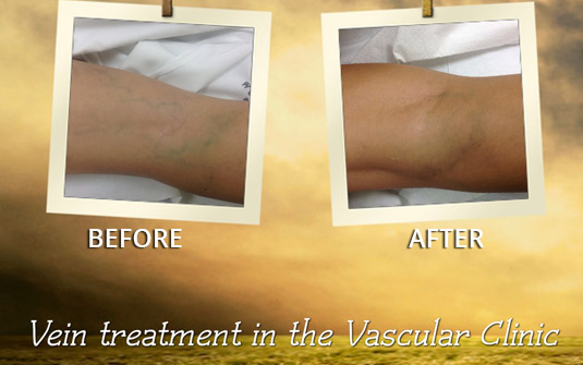 Varicose veins