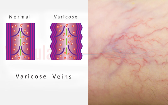 Varicose veins