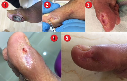 Foot care – Diabetes