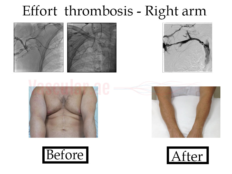 Effort thrombosis – Arm DVT