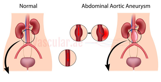 Abdominal aortic aneurysms