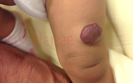 Birthmarks or Congenital Vascular Malformations