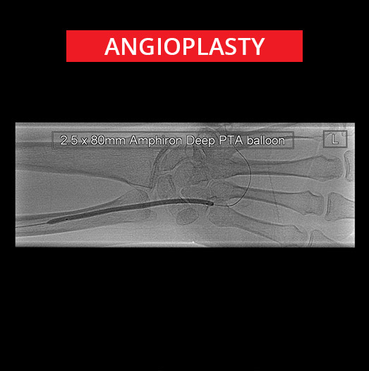 Peripheral Vascular Disease