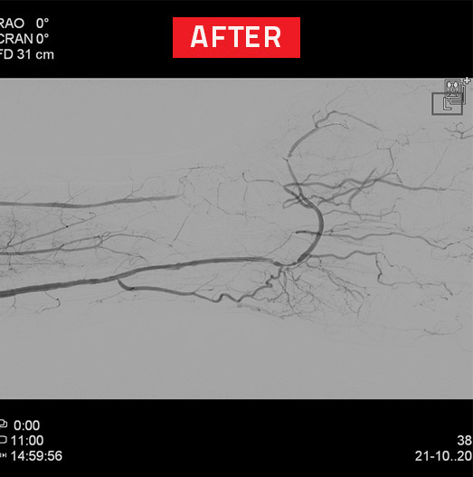 Peripheral Vascular Disease