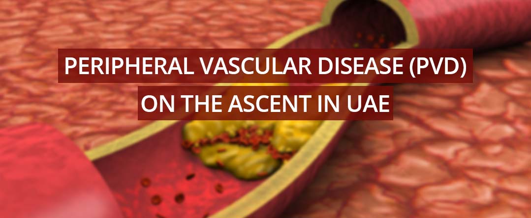 Peripheral Vascular Disease (PVD) on the ascent in UAE