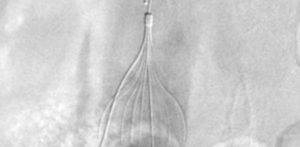 IVC filter for Pulmonary Embolism prevention