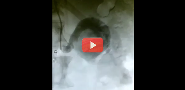 Massive Renal artery aneurysm in a young female – Before treatment