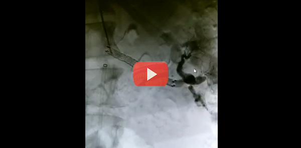 Massive Renal artery aneurysm in a young female – After treatment with stent