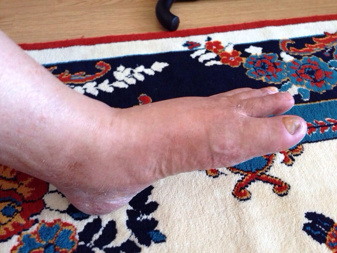 Foot after bypass surgery
