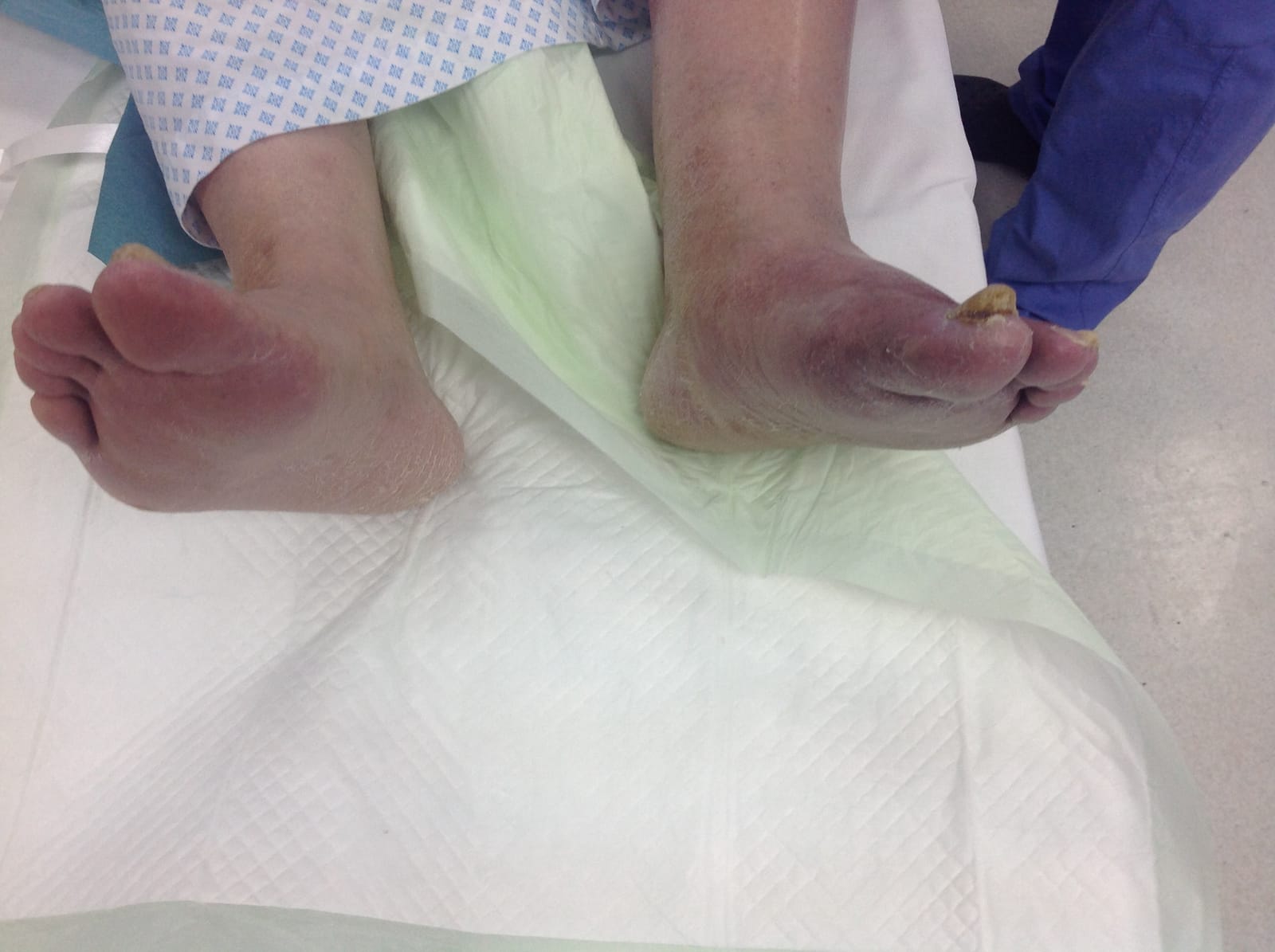 Foot before bypass surgery